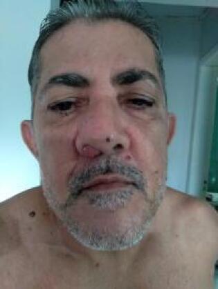  no nariz